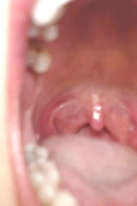 Gardło i usta rożny sznurki Uvula Tonsils Uvula