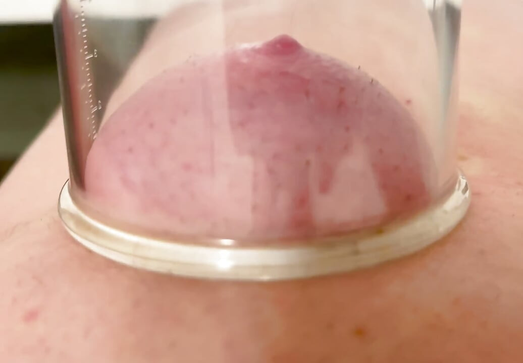 Nipple sucker