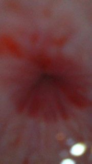 Endoscope from urethral opening to bladder