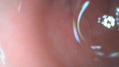 Anal endoscope