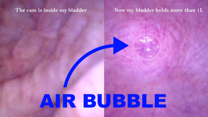 POV Endoscope Catheter Bladder Inflation thumbnail