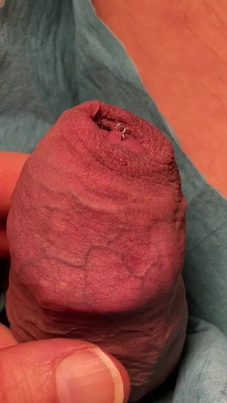 Mini Akkupunktur Nadeln