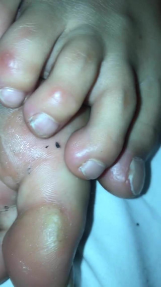 To hot sweaty feet