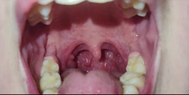 A Close-up of My Throat
