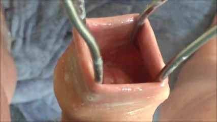 Foreskin with three cumshots !