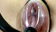 Vaginal Deformation Under the Influence of a Vacuum Pump