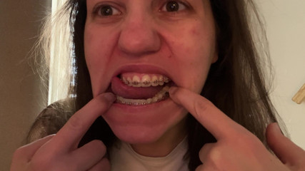 Licking Your Braces with Your Tongue