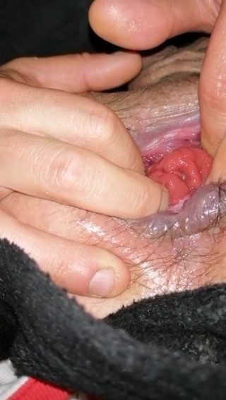 Anal Prolapse Fingering