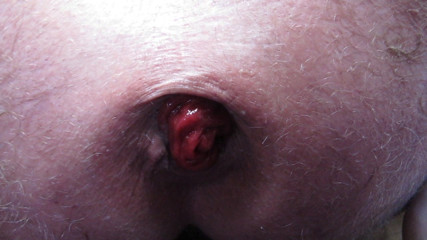 prolapse