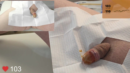 20 French Foley Catheter Insertion