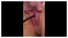 Dilator in My Pisshole