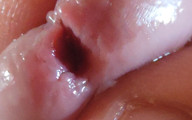 Dilation of the Glans Eye Has a Pleasant Surprise.