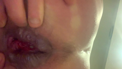 Anal Gape Prolapse