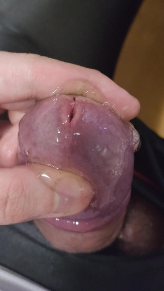 I injected gel made from my urine into my bladder