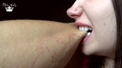 Hard biting of male fingers and arm