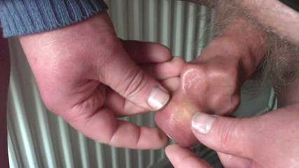 Foreskin with 3 dice and a table tennis ball