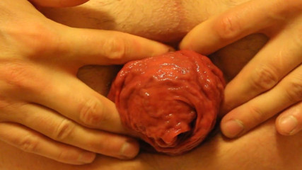 Prolapse Acting