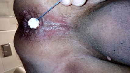 Tampong removal