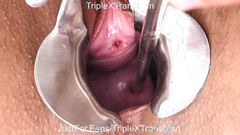 Extreme Cervix Penetration, Sounds, Speculum, Uterus Dilation