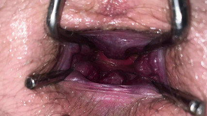 4 inch stretch cauliflower prolapse