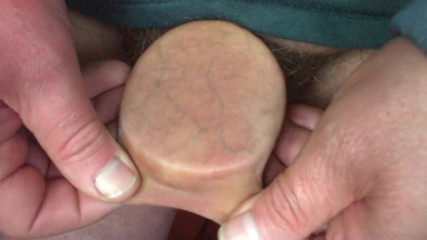 Foreskin with 3 dice and a plastic lid