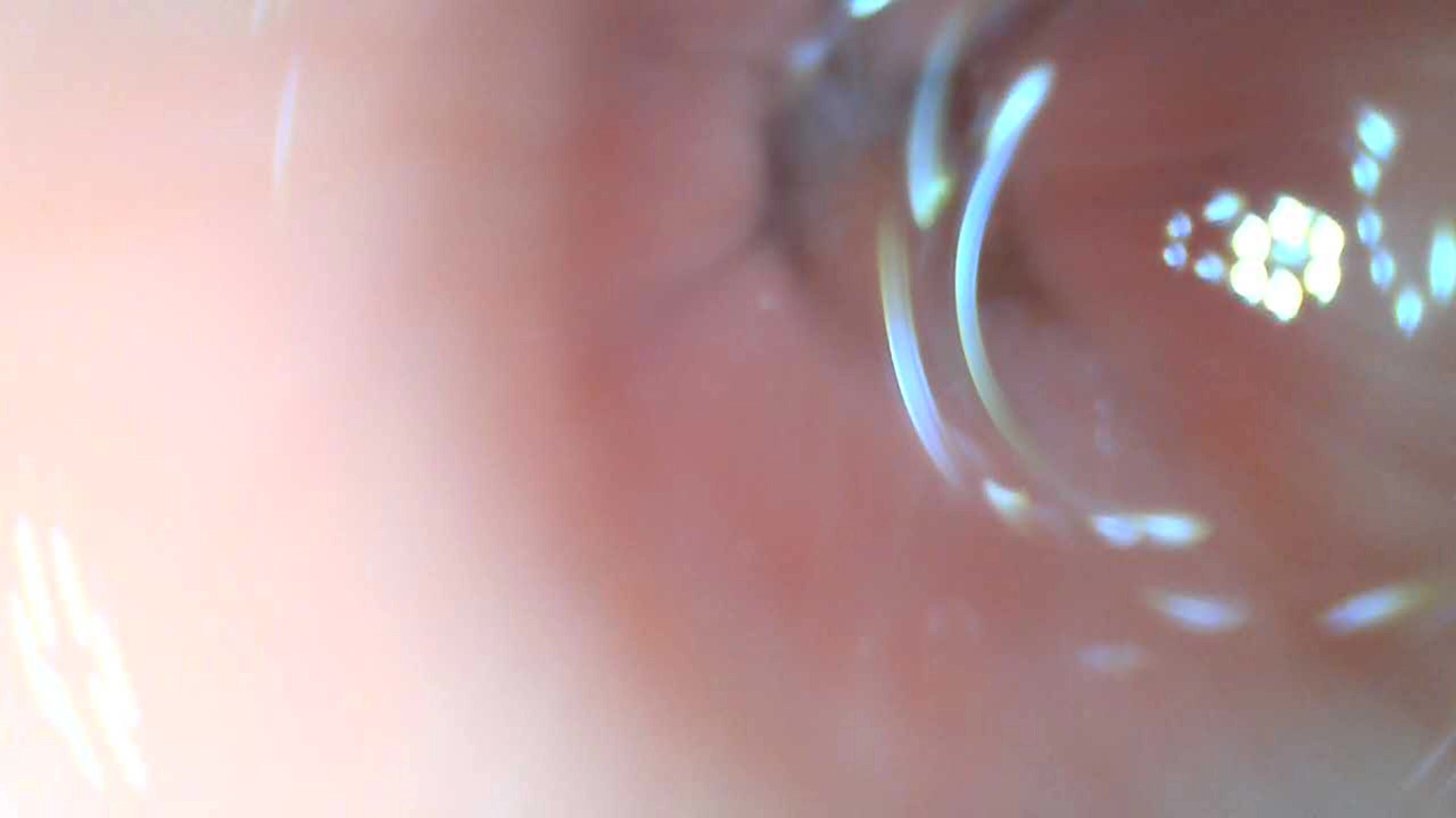 Anal endoscope