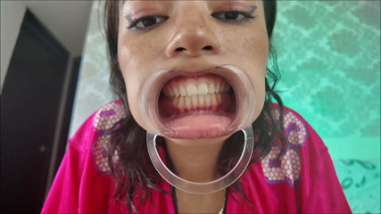 Cheeks Pulled Apart Teeth Exposed