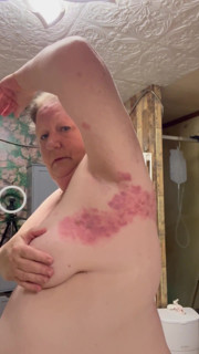 Bad Case of Shingles