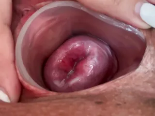 Small cervix without dilating